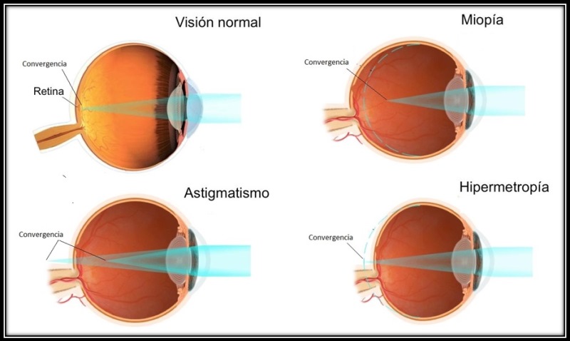 miopia-astigmatismo-hipermetropia